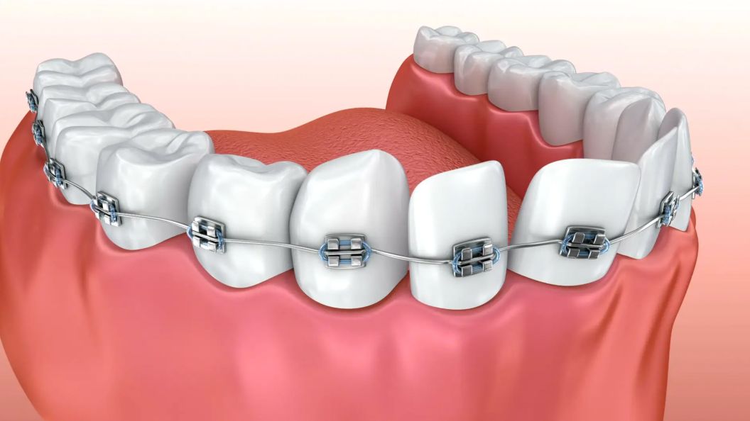 Metal Braces Video